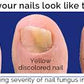 Gofungal - Nail Fungi Remover