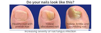 Gofungal - Nail Fungi Remover